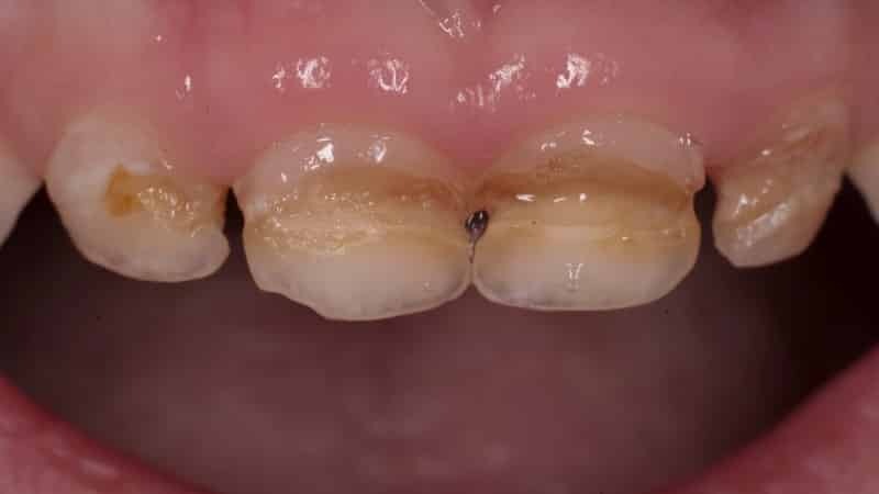 Foto gule tænder