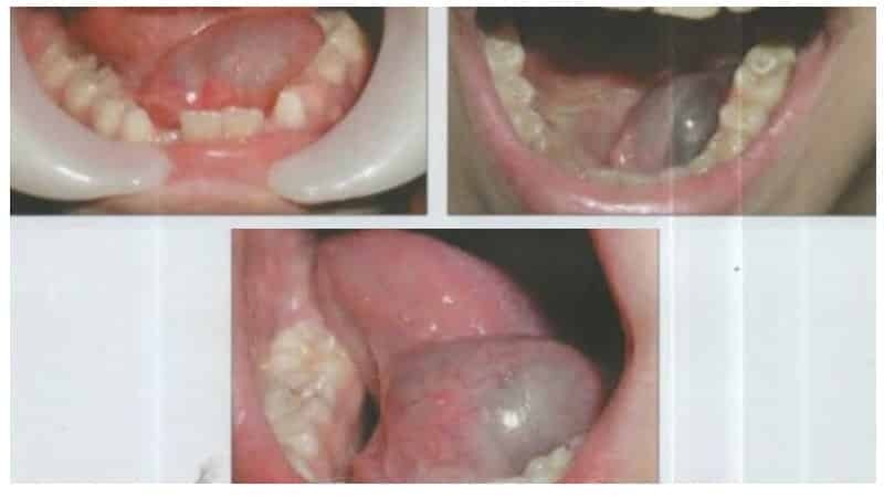 Cyst of the salivary gland: photo and treatment with folk remedies