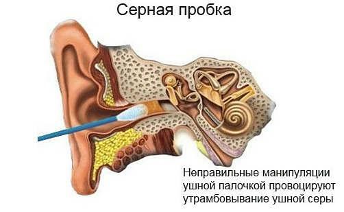 botemedel mot öronproppar