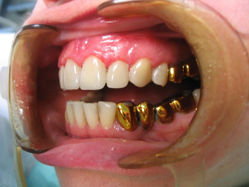 Popis mostní zubní náhrady