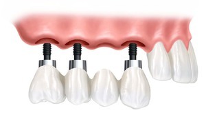 Delvise og fuldstændige tandproteser