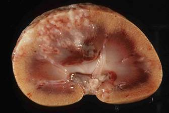 Wat gebeurt er in de nieren met tubulointerstitiale nefritis?