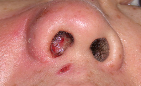 Herpetische Infektion in der Nase