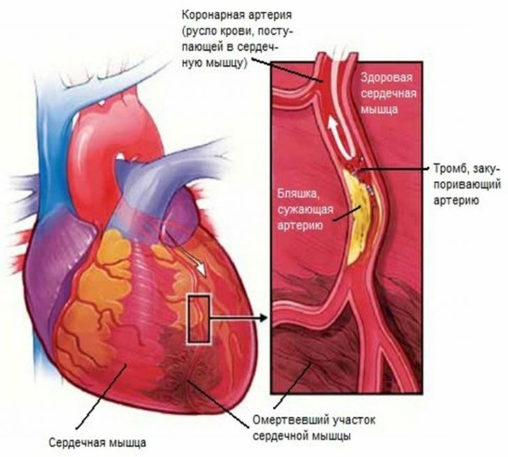 Causes of myocardial infarction