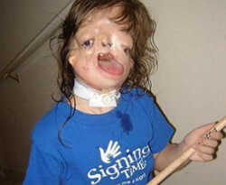 Tricker Collins Syndrome