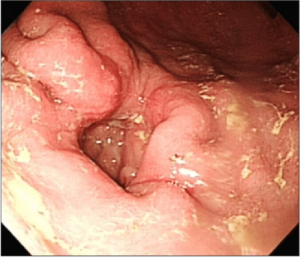 Procedúra gastroduodenoscopy