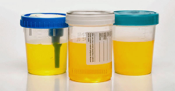 testovi urina: vrste i rezultati dekodiranja