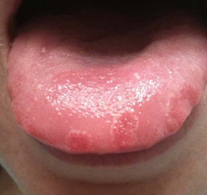 stomatitis v jeziku zdravljenje na domu