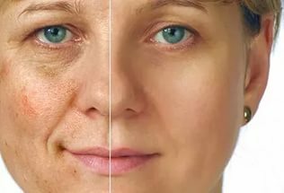 כתמים חומים על הפנים: גורם טיפולי