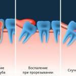 Inflammerat tandkött barnsjukdomar