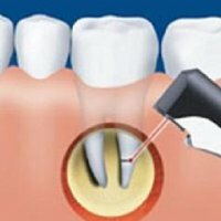 What teeth can be used to resect the root?