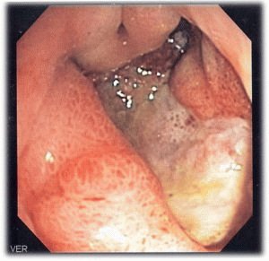 Kan dumplings met gastritis: effect op de maag