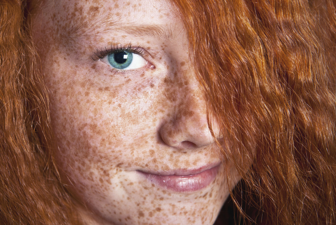 How to remove freckles at home quickly and permanently?