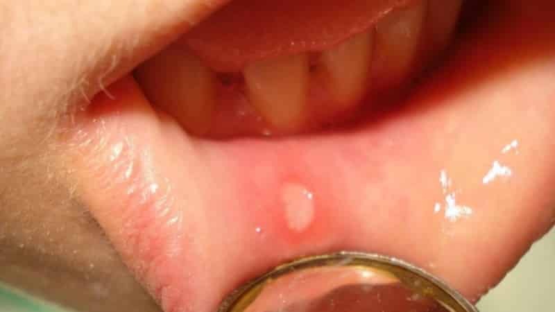Blase an der Lippe im Innern