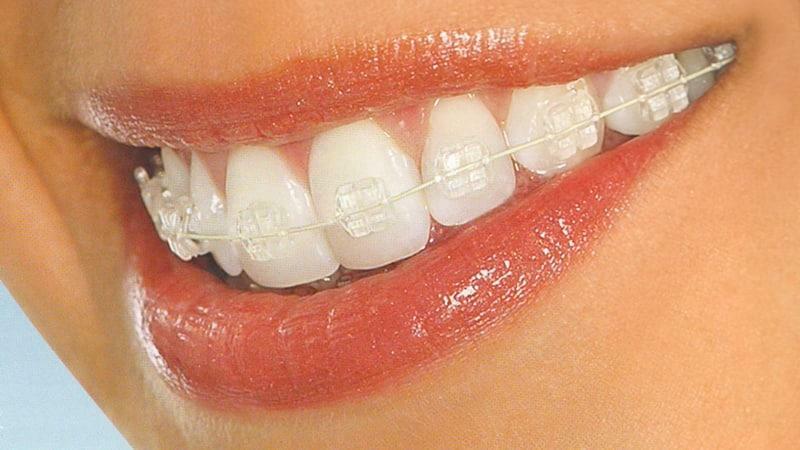 Begradigung Zähne zu Hause Klammern