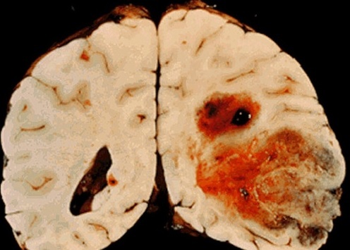 Glyoblastom možganov
