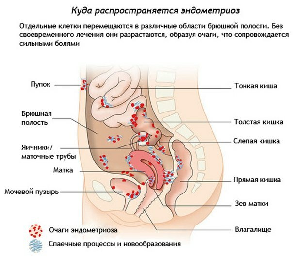 Types van endometriose.Endometriose en zwangerschap