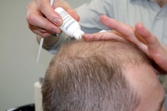 Rette for baldness for menn: anmeldelser av narkotika og metoder