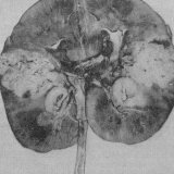 Tuberculose du rein et des voies urinaires