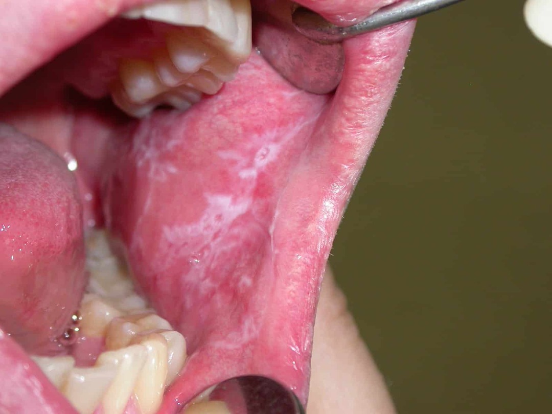 Objawy raka błony śluzowej jamy ustnej zdjęcia