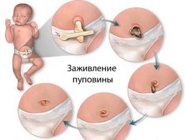 Plač pupok u novorodencov: liečba a prevencia omphalitis