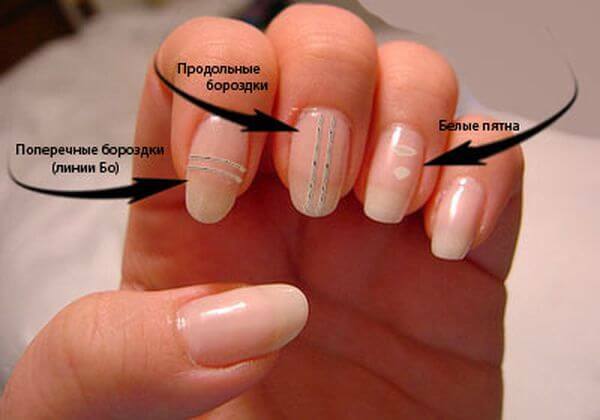 White stripes and spots on the nails - causes, diagnosis and treatment