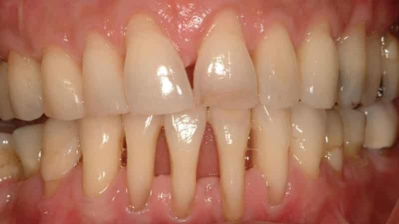 exponering av tandhalsen behandlingen innebär att människor foton