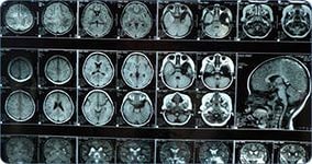 Mozgová tomografia