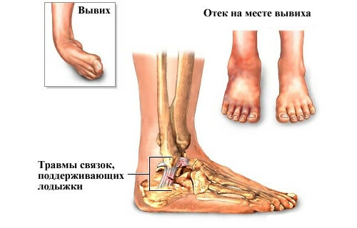 dislocación pies