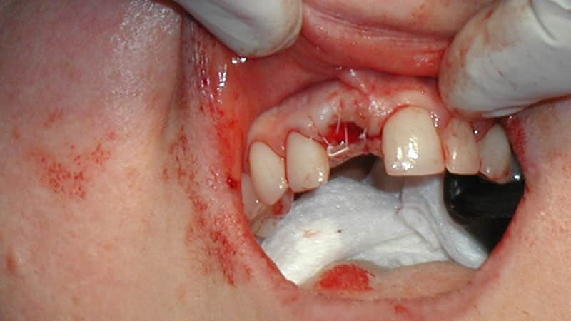Wie die Blutung nach Zahnextraktion zu stoppen? 