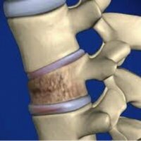 Kompresná zlomenina chrbtice