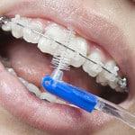 Oral pleje i tilstedeværelse af ortodontiske apparater
