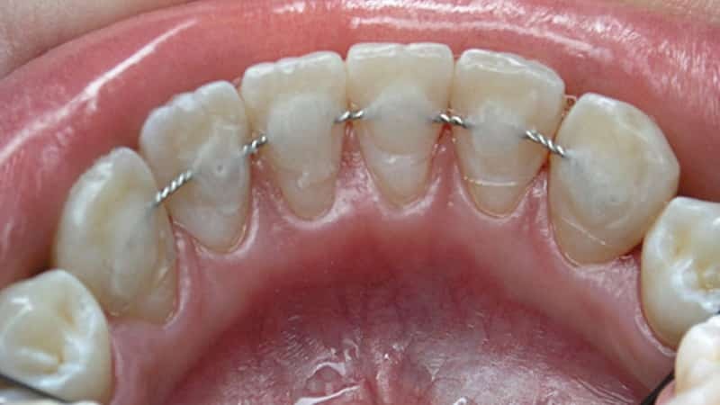 periodontale forskelle sygdom og parodontitis