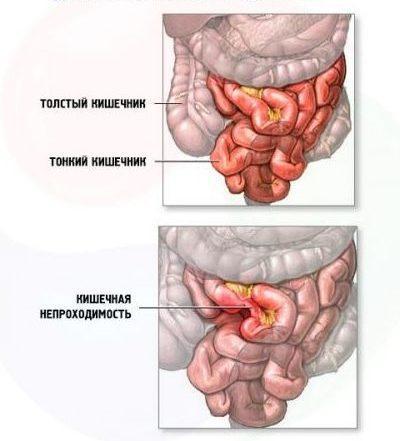 Obstruction intestinale de l'intérieur