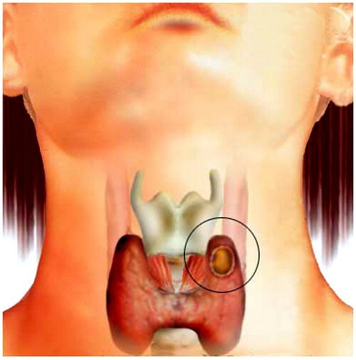 Thyroid Cyste: symptomer og behandling