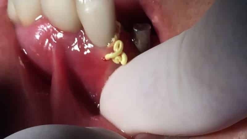 efter avlägsnande av en tand abscess på tandköttet som gör