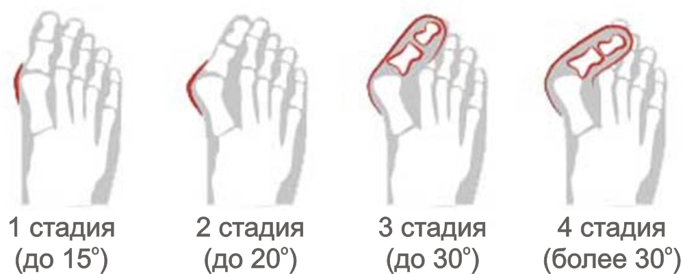 Valgus deformacija palca: uzroci, simptomi, liječenje