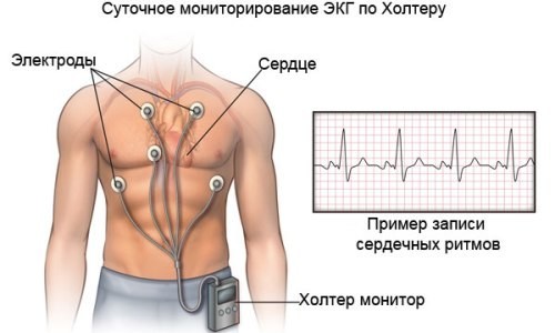 Holter-ECG voor 24-uurs hartbewaking: beschrijving, efficiëntie en diagnostisch principe