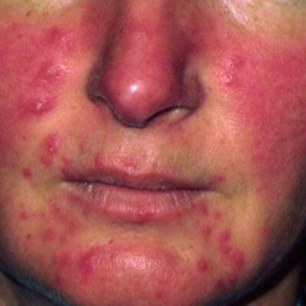Rosacea on the face: photos, symptoms, treatment of rosacea