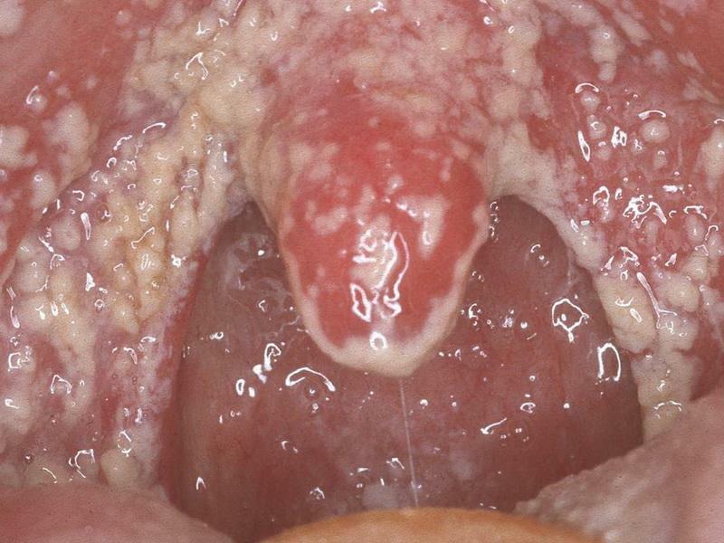 hvite flekker i munnen i en voksen