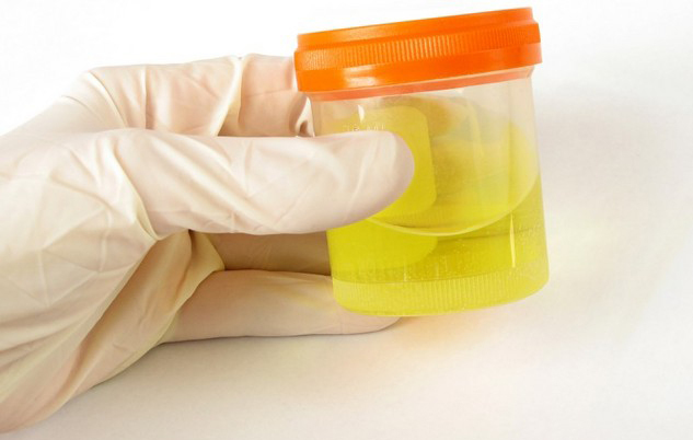 Protein in urine with renal failure
