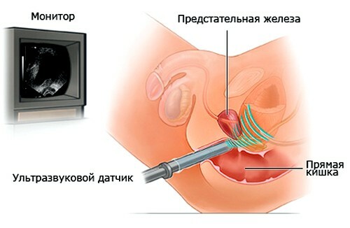 Transrektaler Ultraschall