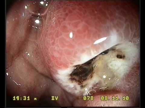Ring-cell carcinoma of the stomach