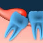 Warum entzündetes Zahnfleisch und wie sie behandeln