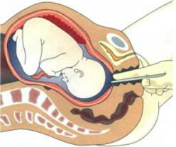 amniotomija