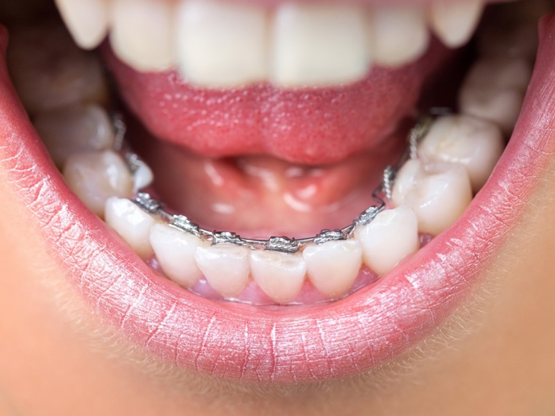 Combien sont des accolades sur les dents, photo réussie après correction, le prix est différent supports, conseils dentistes