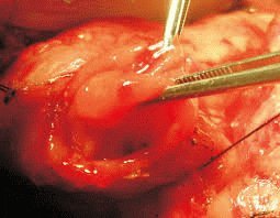 Chirurgie van het ulceratieve gebied van de twaalfvingerige darm