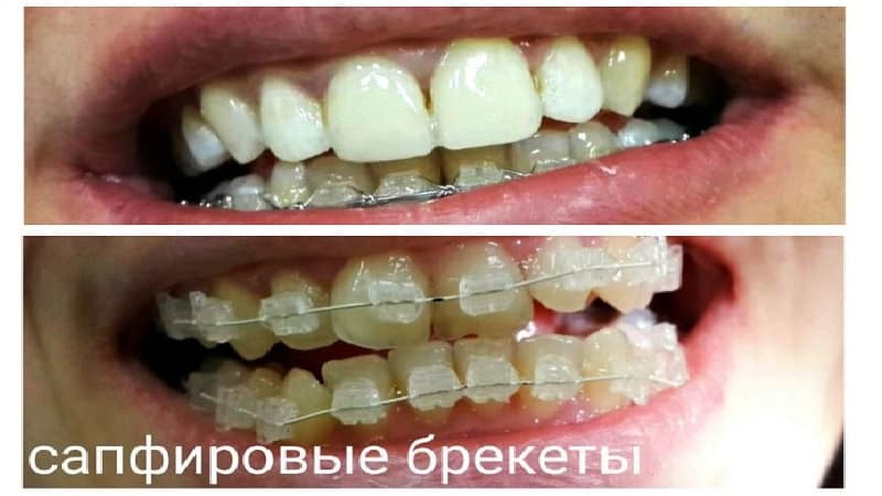 Ausrichtung von Zahnklammern Fotos vor und nach