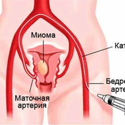 Embolization of uterine arteries
