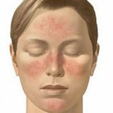 Rosacea - Causes and Treatment